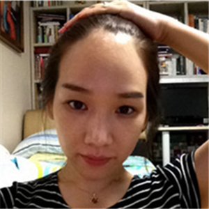 去年在格萊美做了頭發(fā)種植，看看前后對比和恢復(fù)果照片吧~~