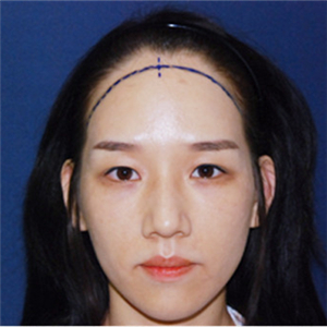 去年在格萊美做了頭發(fā)種植，看看前后對比和恢復(fù)果照片吧~~