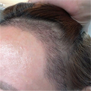 分享我頭發(fā)種植前后和恢復(fù)過程的圖片，是格萊美黃興勇做的哦~~~