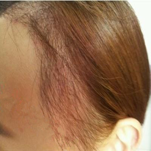 分享我頭發(fā)種植前后和恢復(fù)過程的圖片，是格萊美黃興勇做的哦~~~