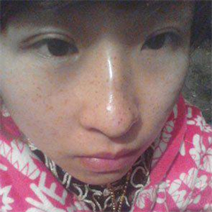 去格萊美做了激光去雀斑，有恢復(fù)前后的對(duì)比照片哦，還不錯(cuò)~~