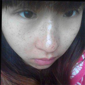 去格萊美做了激光去雀斑，有恢復(fù)前后的對(duì)比照片哦，還不錯(cuò)~~