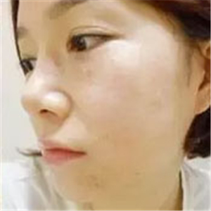 做了激光去雀斑前后對(duì)比照片分享，黃俊俊的技術(shù)很好哦！