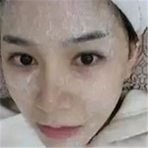 做了激光去雀斑前后對(duì)比照片分享，黃俊俊的技術(shù)很好哦！