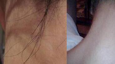 激光脫毛前后對(duì)比圖，8000元全身激光脫毛