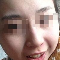 花費4000元做了激光祛斑，終于把雀斑消滅了555555