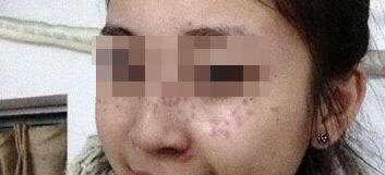 花費4000元做了激光祛斑，終于把雀斑消滅了