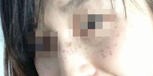 激光祛斑費用4000元