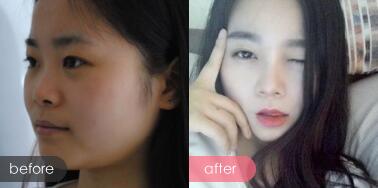 隆鼻前后的對比照片