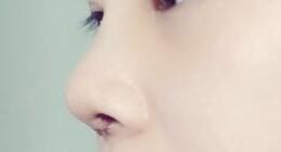 隆鼻術(shù)后第6天
