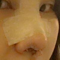 假體隆鼻，耳軟骨墊鼻尖，鼻頭縮小等隆鼻整形分享