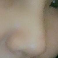 假體隆鼻，耳軟骨墊鼻尖，鼻頭縮小等隆鼻整形分享