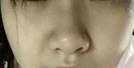 鼻子整形前的圖片，隆鼻案例分享