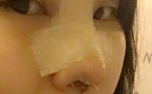 隆鼻整形手術(shù)分享