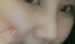 假體隆鼻，耳軟骨墊鼻尖，鼻頭縮小等隆鼻整形分享