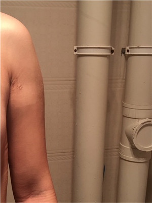 手臂吸脂后變軟妹紙 美萊鄧正輝做的