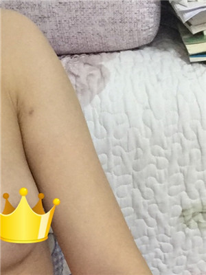 手臂吸脂后變軟妹紙 美萊鄧正輝做的