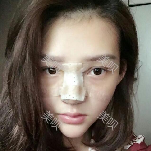 重慶聯(lián)合麗格做的硅膠假體隆鼻自我感覺很漂亮哦