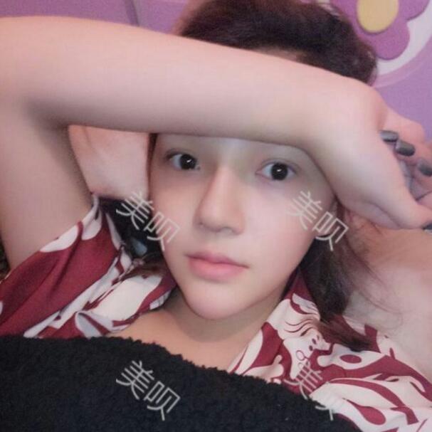 重慶聯(lián)合麗格做的硅膠假體隆鼻自我感覺很漂亮哦