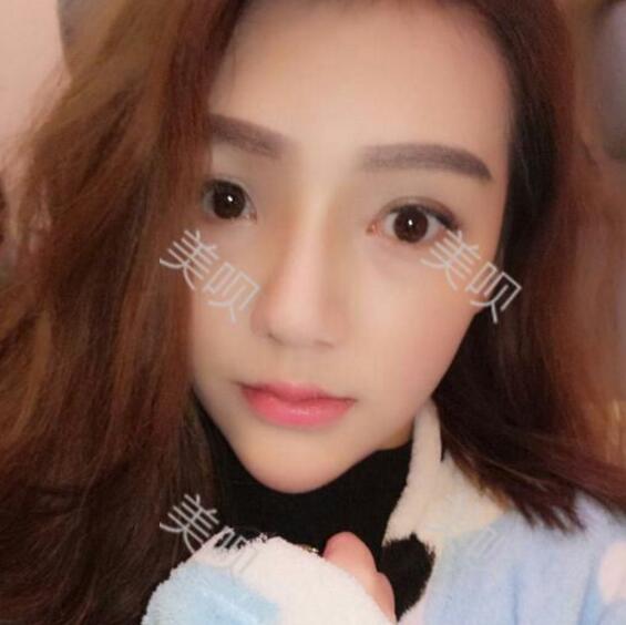 重慶聯(lián)合麗格做的硅膠假體隆鼻自我感覺很漂亮哦
