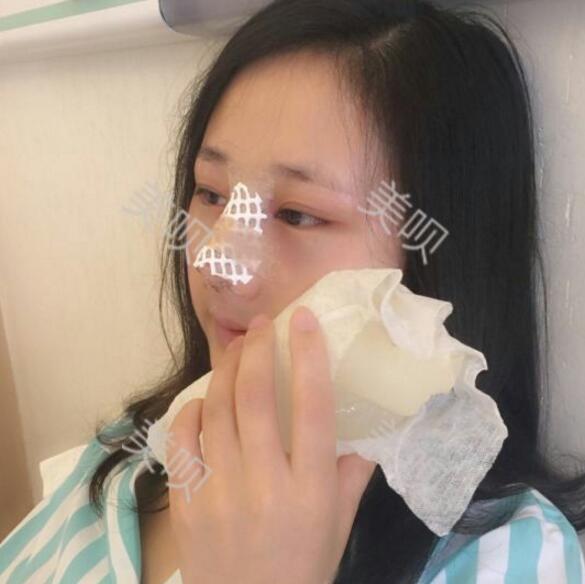 把自己的自體脂肪隆鼻過程分享給大家我是真的變美了