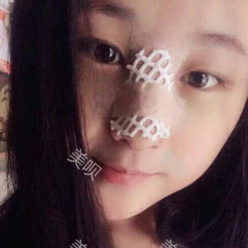 把自己的自體脂肪隆鼻過程分享給大家我是真的變美了