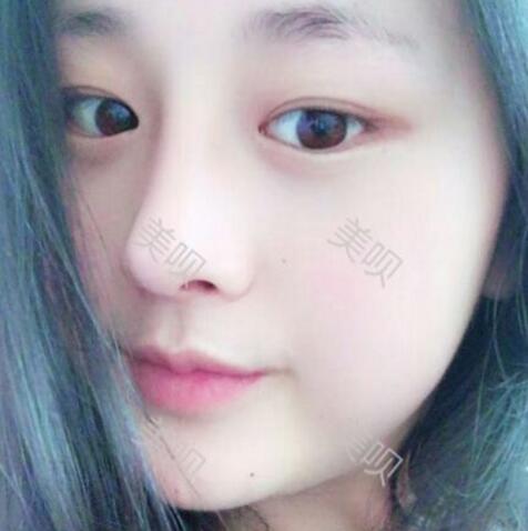 把自己的自體脂肪隆鼻過程分享給大家我是真的變美了