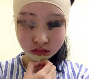 磨骨瘦臉后，終于擺脫大餅臉了！