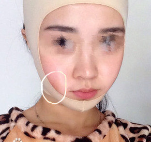 磨骨瘦臉后，終于擺脫大餅臉了！