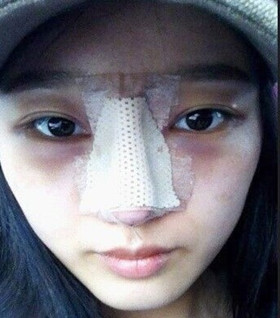 假體隆鼻手術過程前后對比圖片