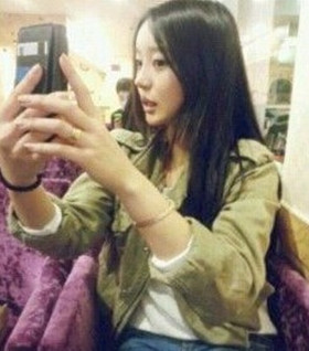 假體隆鼻手術過程前后對比圖片