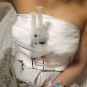 去年10月做的假體隆胸手術(shù)，大家來看看怎么樣