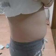 北京炫美腹部吸脂術(shù)后 腰腹部吸脂后一周照片