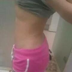 北京炫美腹部吸脂術(shù)后 腰腹部吸脂后一周照片