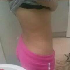 北京炫美腹部吸脂術(shù)后 腰腹部吸脂后一周照片