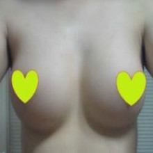 假體隆胸讓我告別小平胸 感謝北京彤美