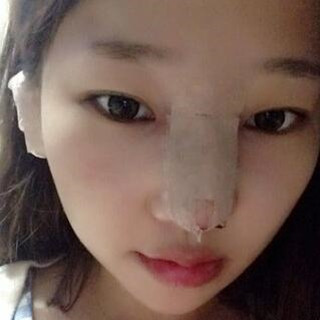 耳軟骨隆鼻改變了我的塌鼻梁 北京彤美做的果很棒