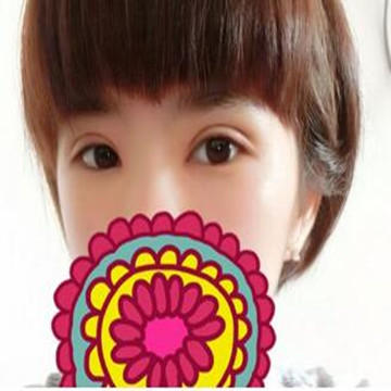 雙眼皮修復(fù)成功辣  再也不用擔(dān)心異樣的眼光辣