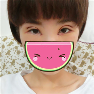 做park法雙眼皮手術(shù)一個月了，果很好，有恢復(fù)過程照片哦~~