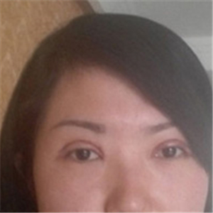 楊亞益醫(yī)生做的雙眼皮+開眼角，果不錯，看看我的恢復(fù)照片~~~