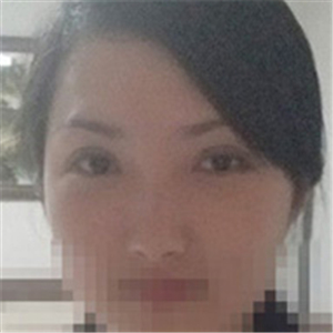 楊亞益醫(yī)生做的雙眼皮+開眼角，果不錯，看看我的恢復(fù)照片~~~