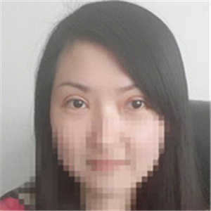 楊亞益醫(yī)生做的雙眼皮+開眼角，果不錯，看看我的恢復(fù)照片~~~