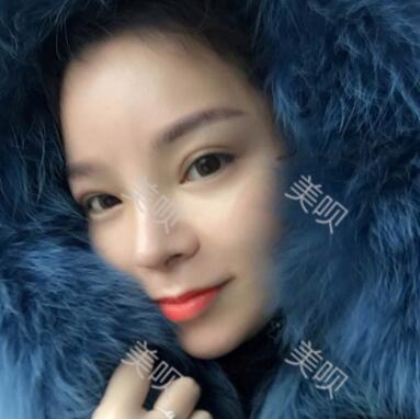 我做的自體脂肪隆鼻果杠杠的我很滿意~~~