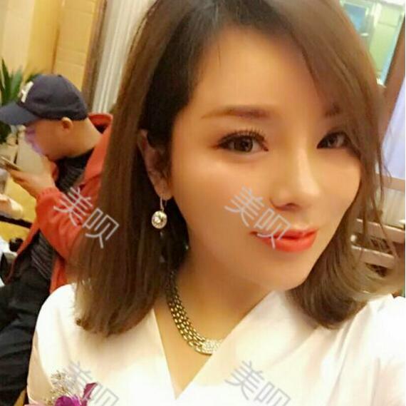 我做的自體脂肪隆鼻果杠杠的我很滿意~~~