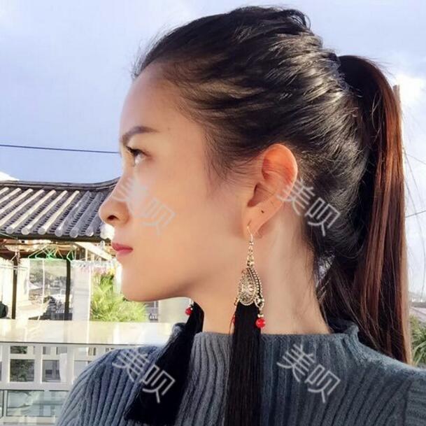 我做了玻尿酸隆鼻后被同學(xué)叫網(wǎng)紅哈哈~~~