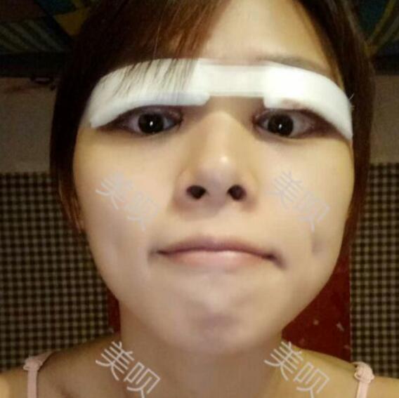 在東莞華美做的切開雙眼皮感覺果棒棒噠