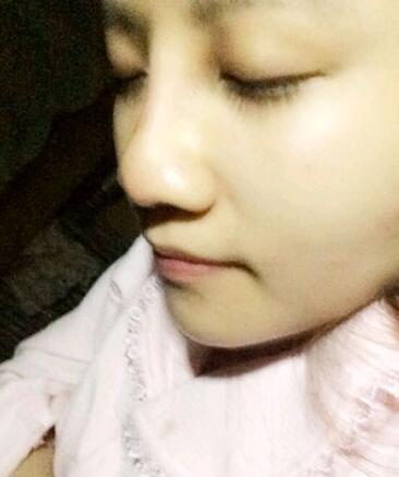 假體隆鼻15天后恢復(fù)果 杭州時(shí)光做的~