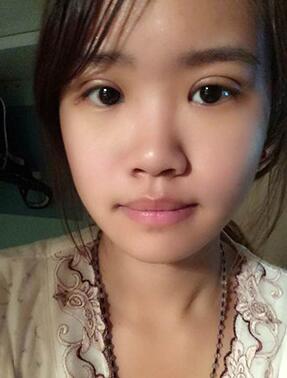 納米x雕雙眼皮15天了~ 我恢復的算快嗎