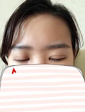 納米x雕雙眼皮15天了~ 我恢復的算快嗎