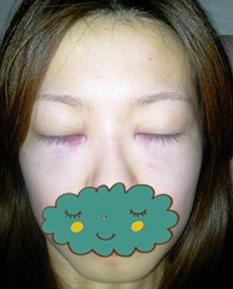 杭州時光激光去眼袋1個月了